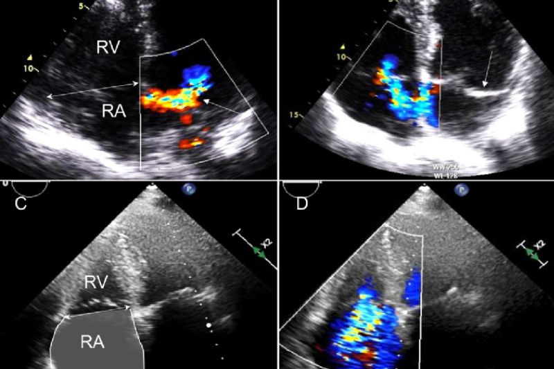 ảnh siêu âm hở van tim 3 lá 1/4