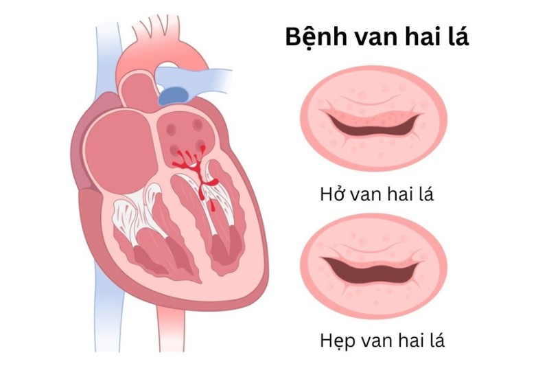 hình ảnh cho thấy hở van tim và hẹp van tim.