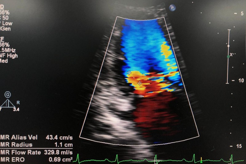 ảnh siêu âm van 2 lá