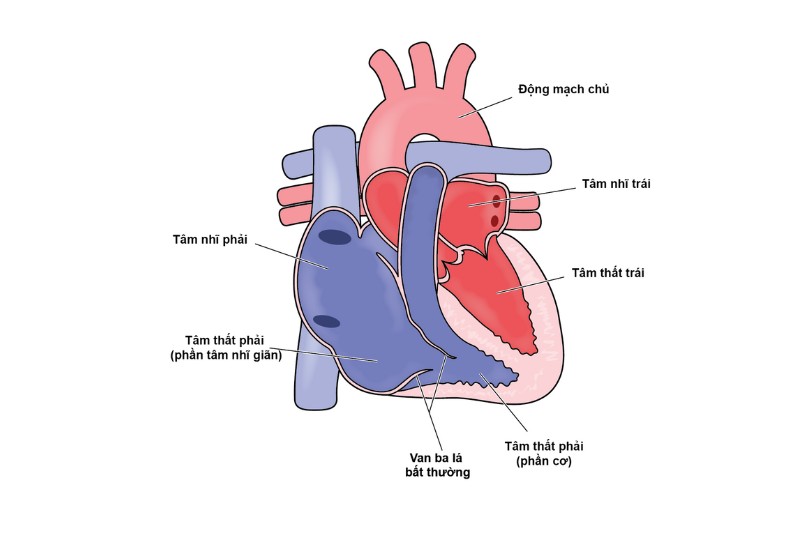 dị tật Ebstein lá van ba lá