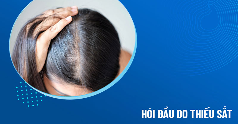 hói đầu do thiếu sắt