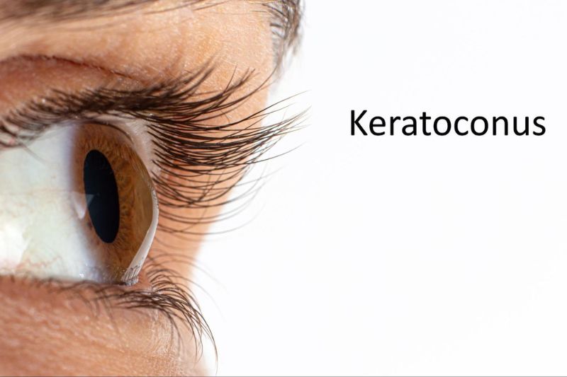 Loạn thị 1 bên thường nếu kèm theo giác mạc hình chóp được xem là bệnh lý.