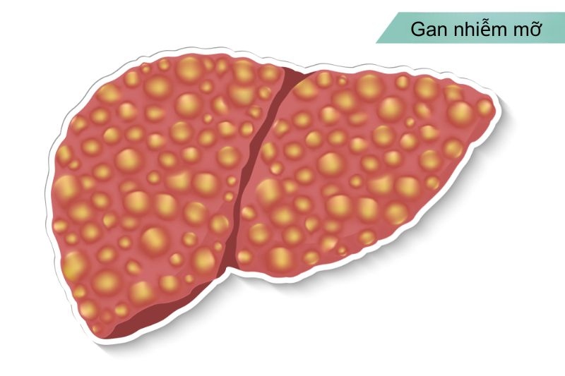 nhiễm gan nhiễm mỡ