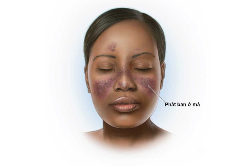 bệnh lupus ban đỏ có thể gây san van 2 lá