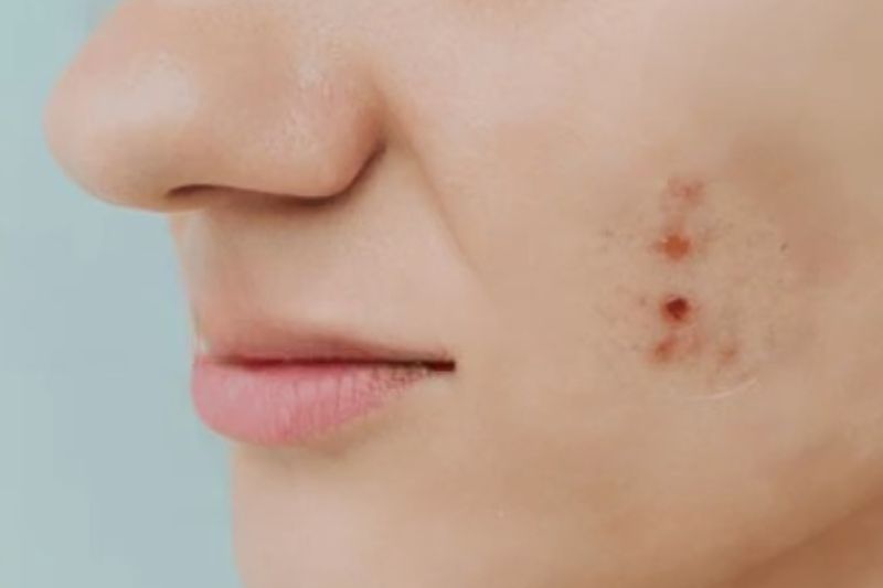 dùng vitamin c giúp điều trị nám