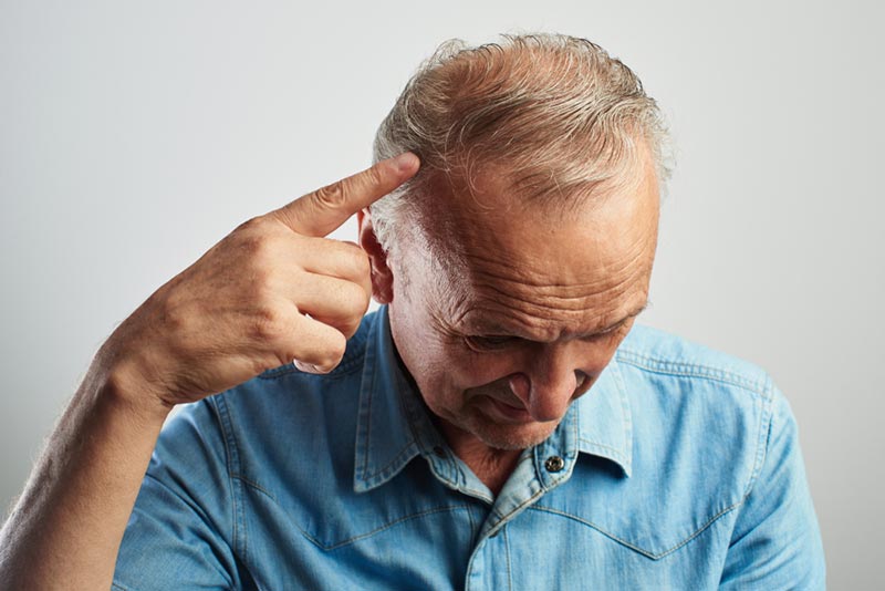 tình trạng hói đầu ở đàn ông