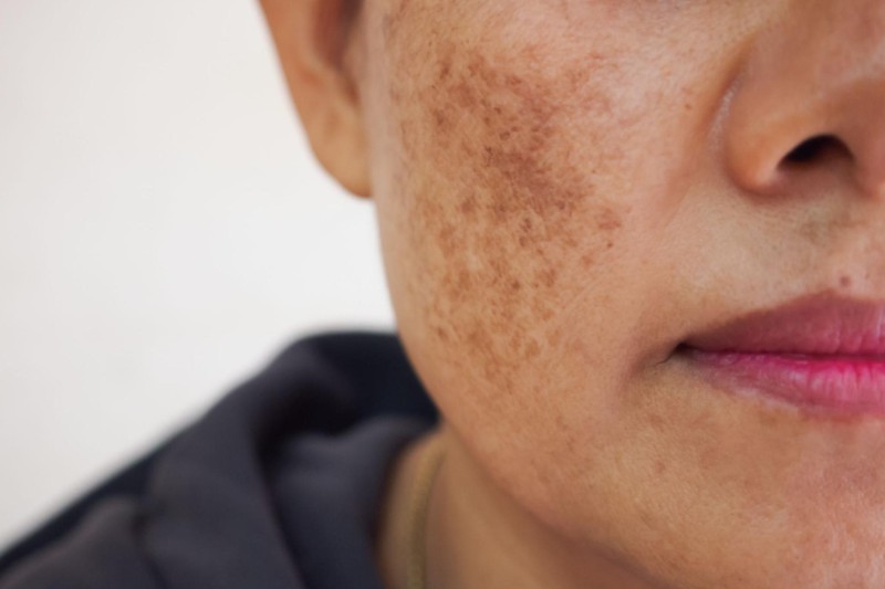 vitamin e có khả năng trị nám