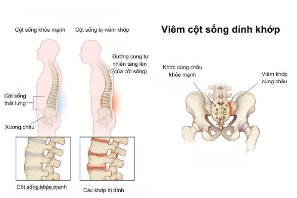 Triệu chứng viêm cột sống dính khớp