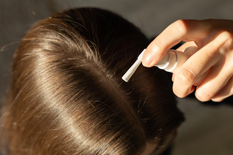 xịt minoxidil chữa hói đầu ở nữ