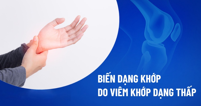 Biến dạng khớp do viêm khớp dạng thấp