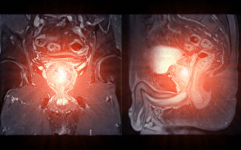 chụp mri tuyến tiền liệt