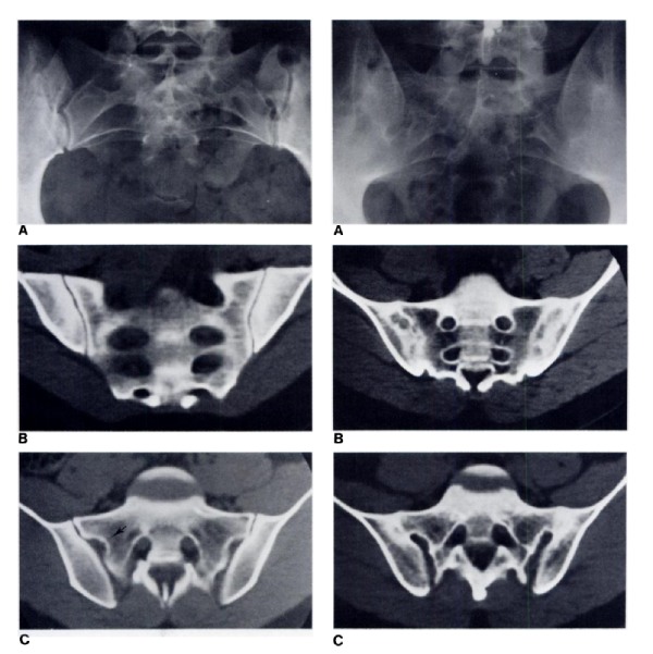 CT viêm khớp cùng chậu
