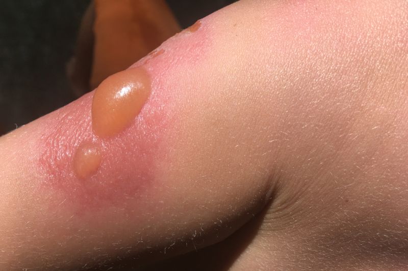 da bị cháy nắng nổi phồng