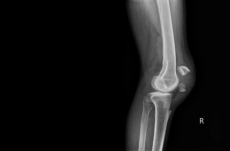 Gãy xương bánh chè đầu gối