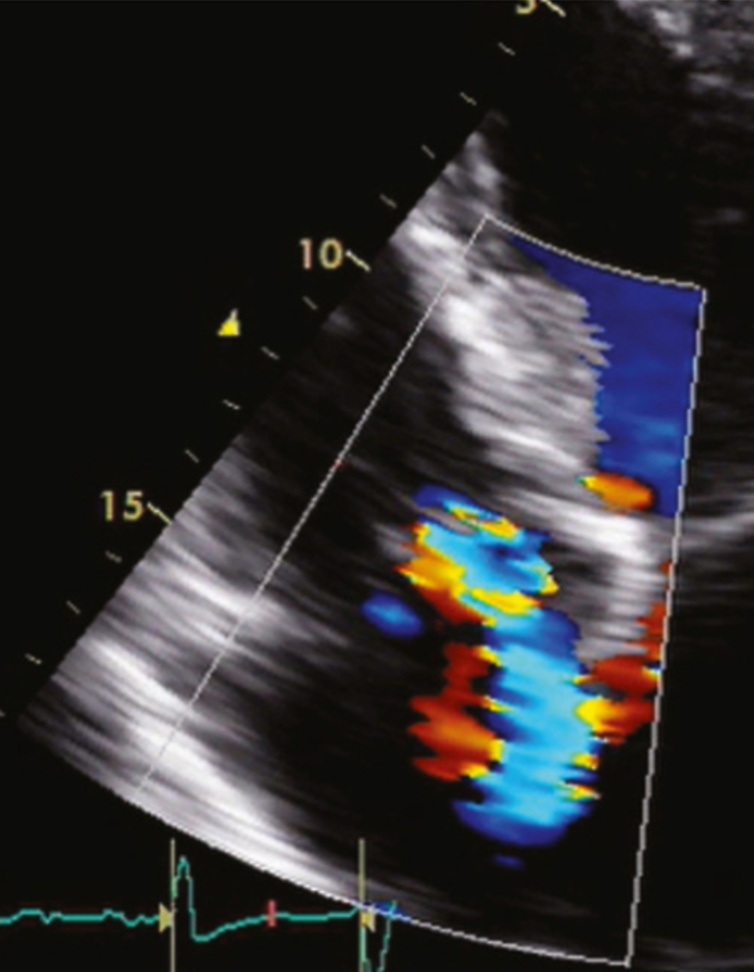 ảnh siêu âm hở van 3 lá 2/4