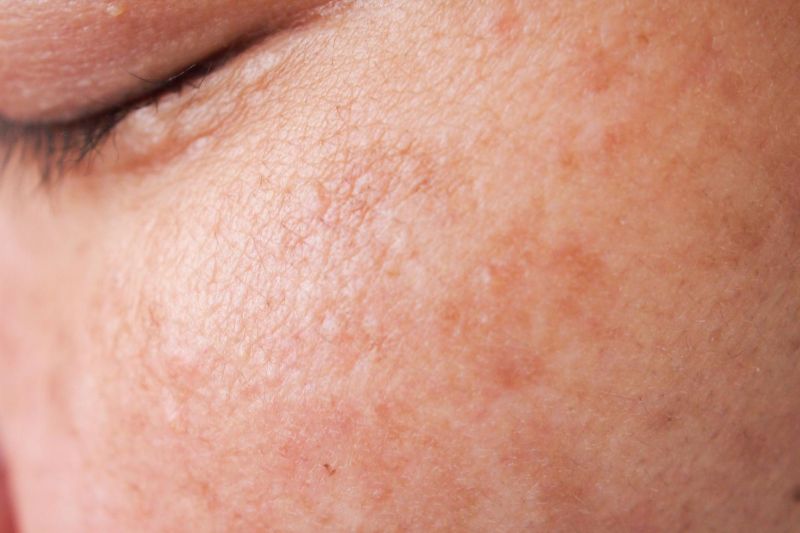 Hydroquinone làm giảm enzyme tyrosinase giúp trị nám