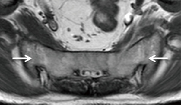 MRI viêm khớp cùng chậu