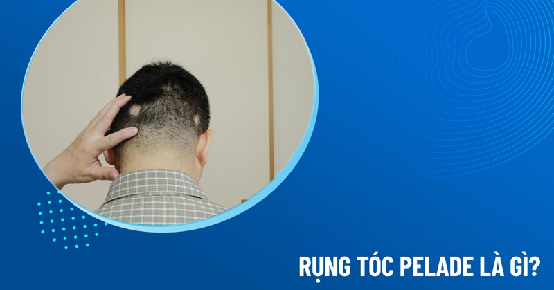 rụng tóc pelade