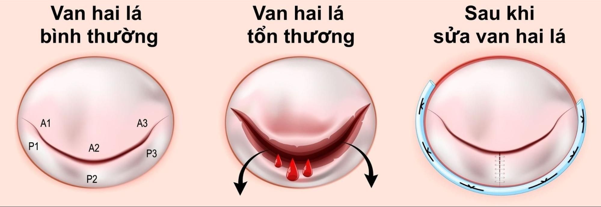 sửa van hai lá giúp van đóng mở hiệu quả