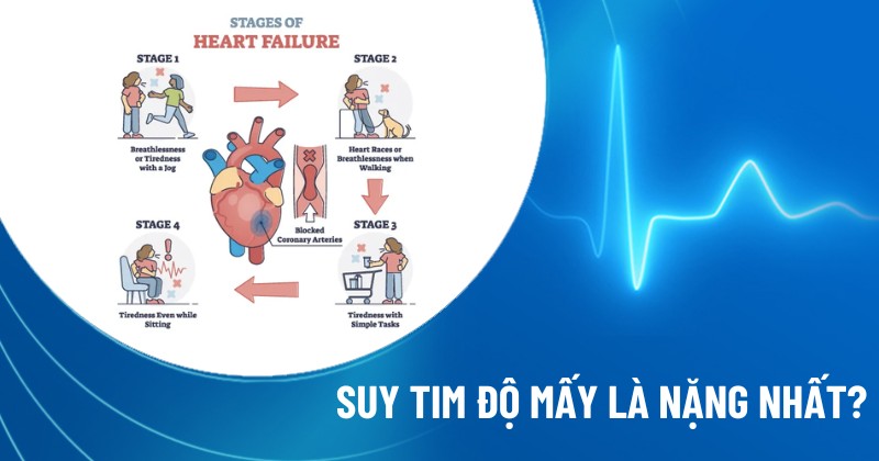 suy tim độ mấy là nặng nhất