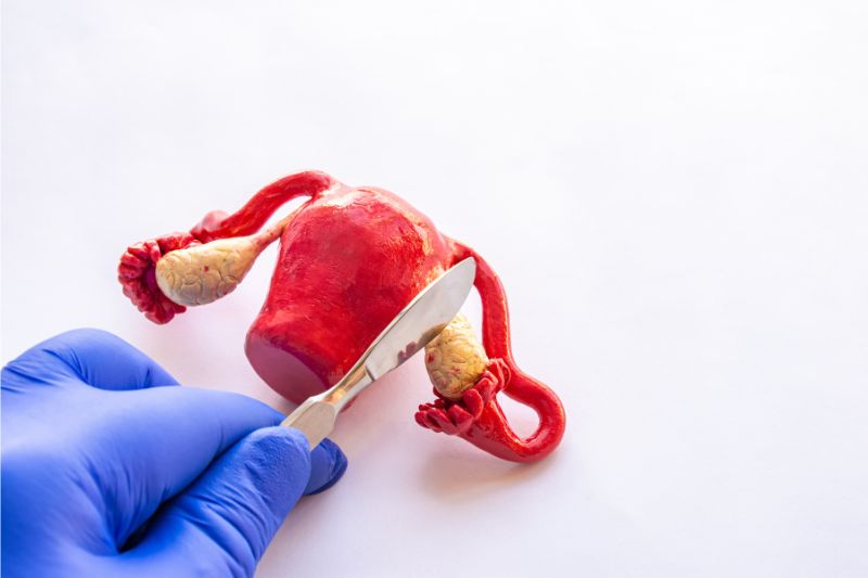 Thực hiện cắt bỏ buồng trứng, tử cung là một trong những nguyên nhân tiền mãn kinh sớm.