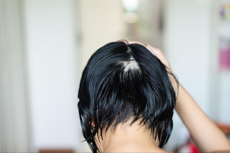 tóc rụng hình mãng tròn