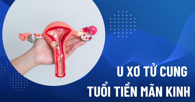U xơ tử cung tuổi tiền mãn kinh