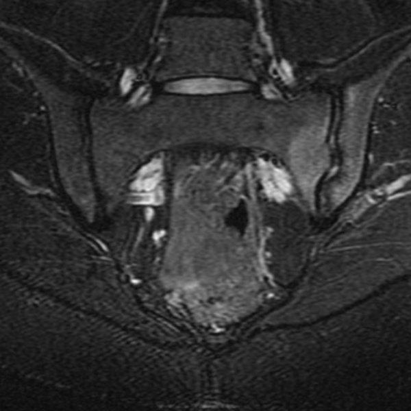 Viêm khớp cùng chậu bên trái