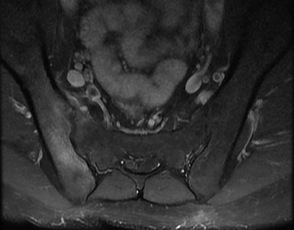Viêm khớp cùng chậu 1 bên
