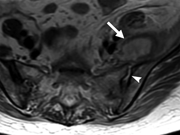 Viêm khớp cùng chậu do vi khuẩn