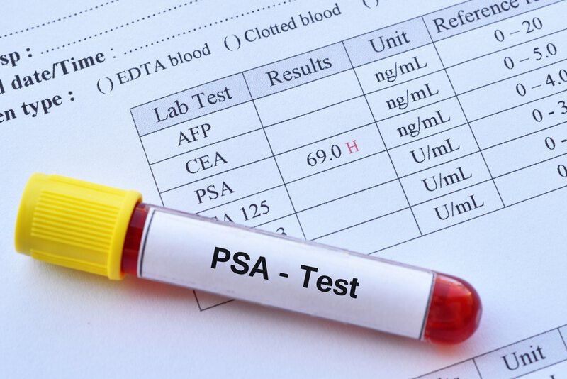 xét nghiệm psa trong máu