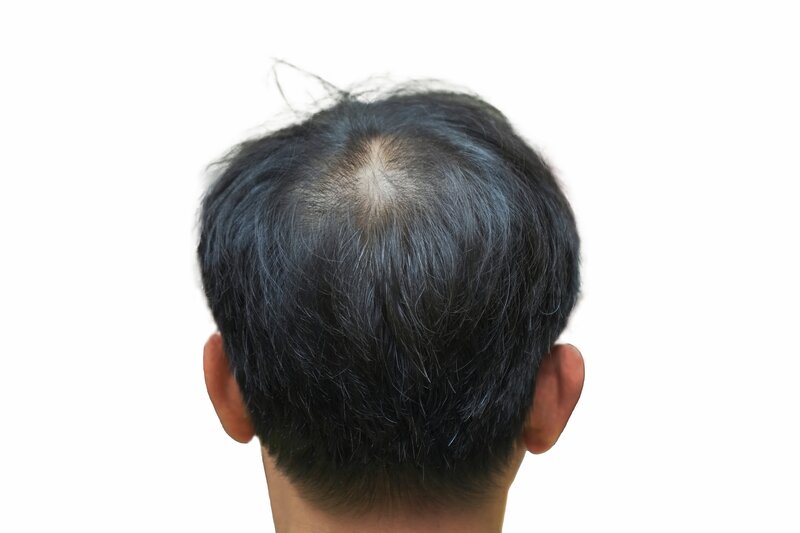 bị hói trên đỉnh đầu