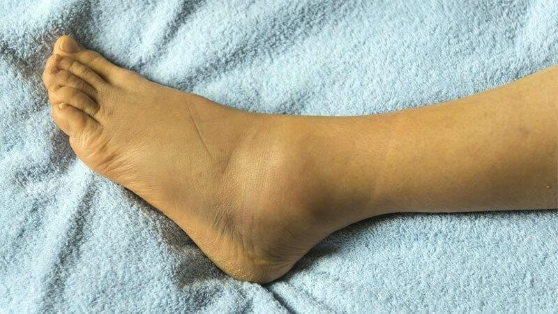 biểu hiện bệnh gan