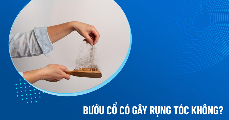 bướu cổ gây rụng tóc