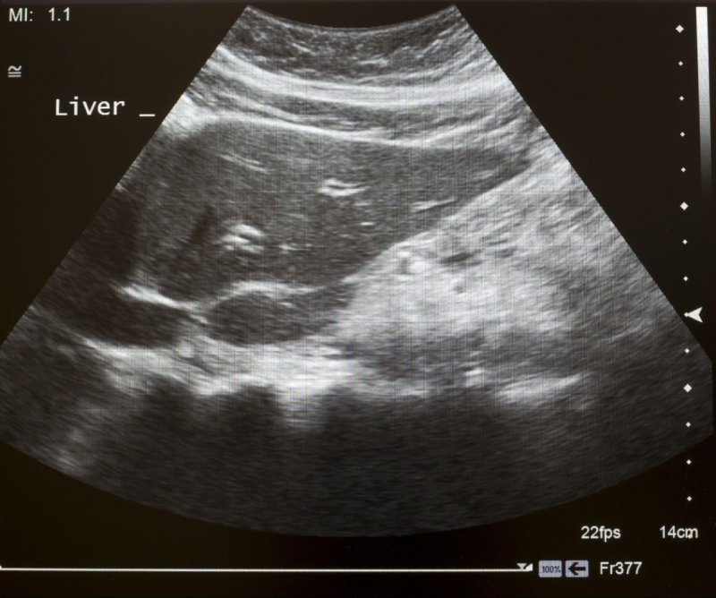 chẩn đoán men gan tăng