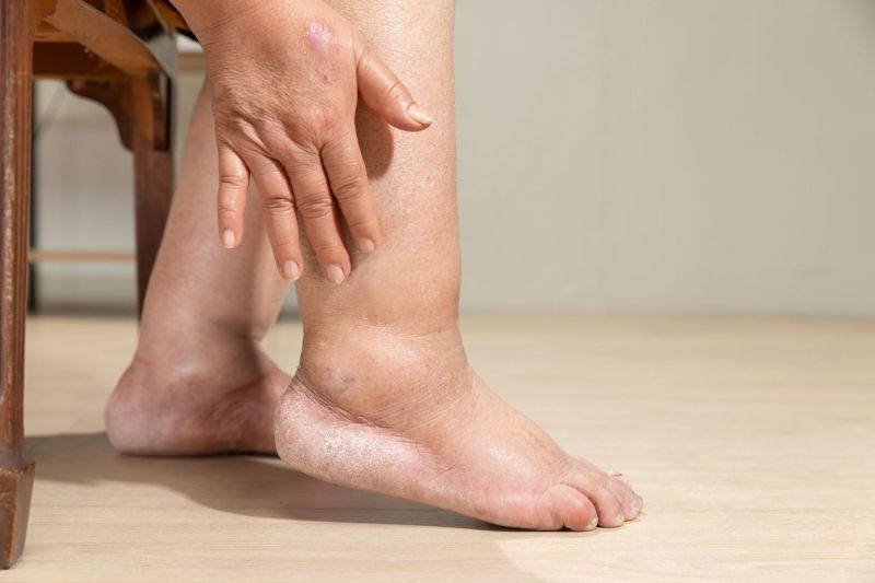 áp lực tĩnh mạch gây phù ngoại biên ở mắt cá chân