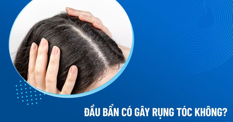 đầu bẩn gây rụng tóc