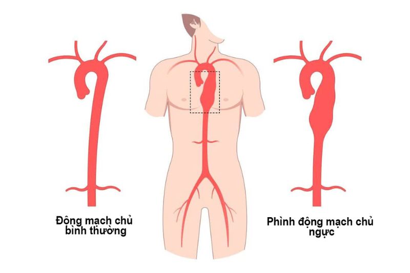 phình động mạch chủ