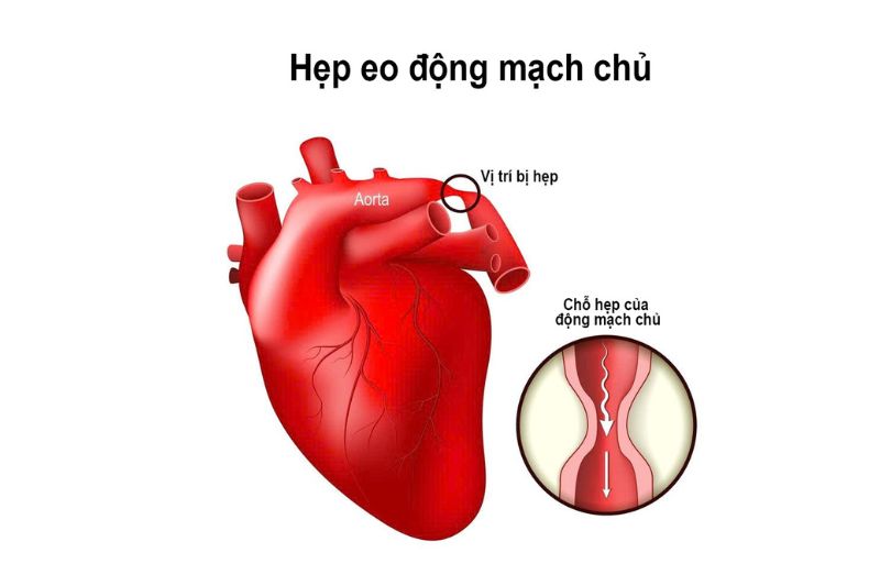 hẹp eo động mạch chủ