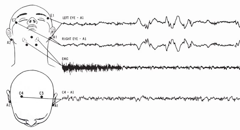 giúp ghi lại hoạt động sóng não xác định giai đoạn giấc ngủ