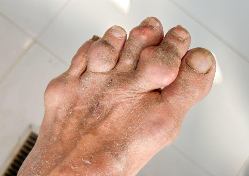 Nguyên nhân gây đau khớp bàn chân