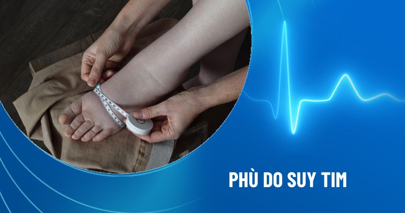 phù do suy tim