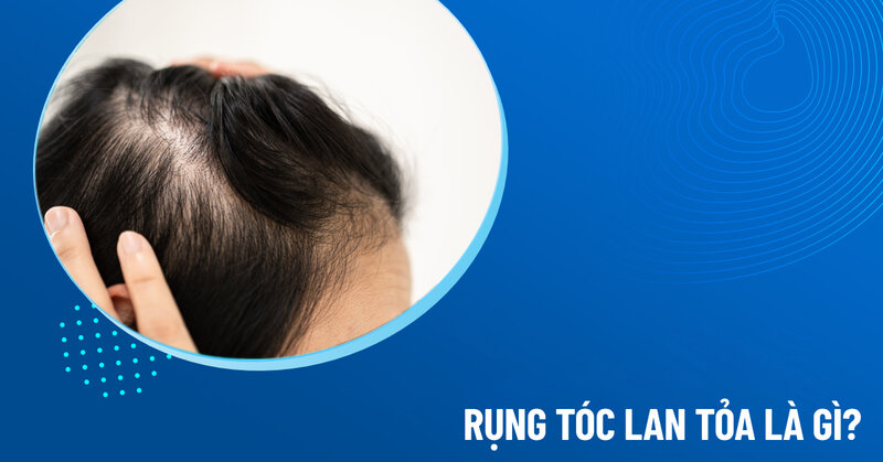 rụng tóc lan tỏa