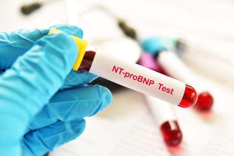 Xét nghiệm peptide lợi niệu NT-proBNP chẩn đoán bệnh tim
