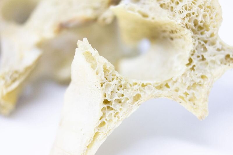 giai đoạn này dẫn đến giảm mật độ xương