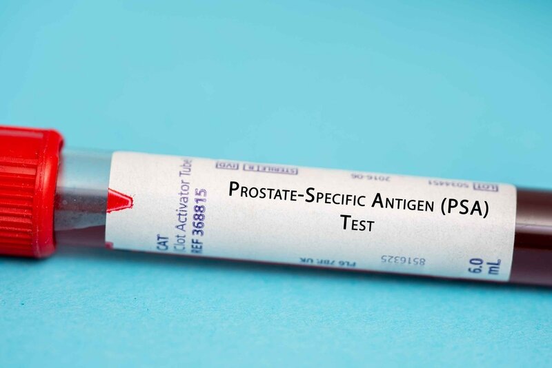 test nồng độ kháng nguyên đặc hiệu tuyến tiền liệt