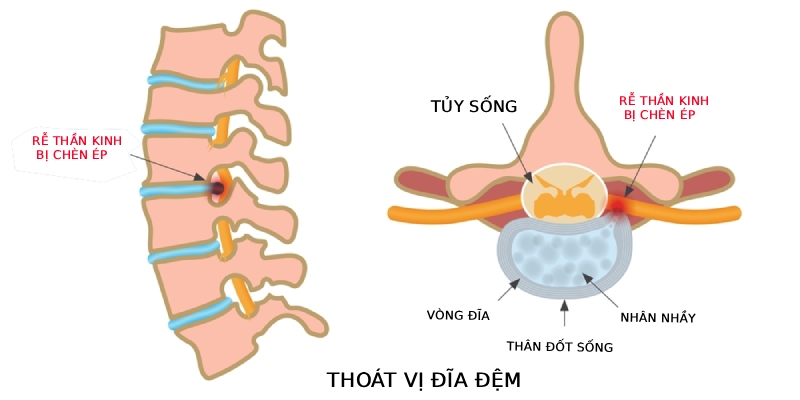 Bao xơ lớp vỏ ngoài đĩa đệm