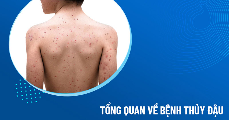 bệnh thủy đậu