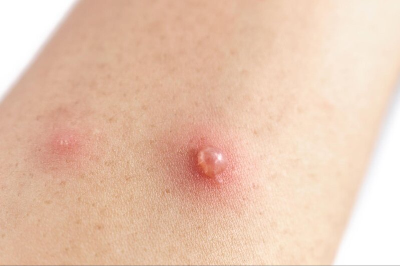 mụn nước thủy đậu