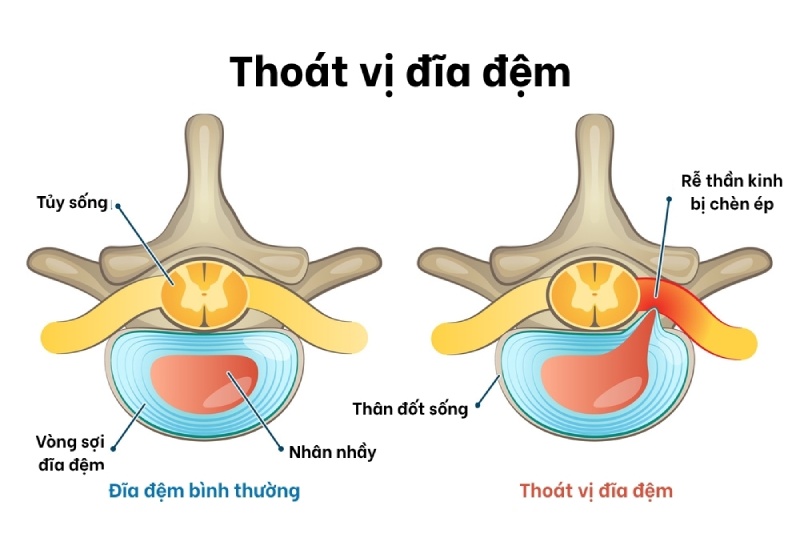 Nhân nhầy bên trong đĩa đệm thoát ra